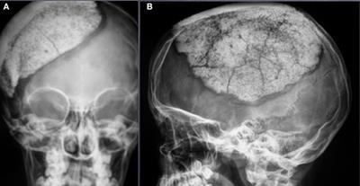 A Multicentric European Clinical Study on Custom-Made Porous Hydroxyapatite Cranioplasty in a Pediatric Population